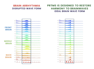 Image: Side by side brain scan images of a brain arrythmia next to an ideal brain wave form