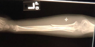 Image: An x-ray of a broken arm