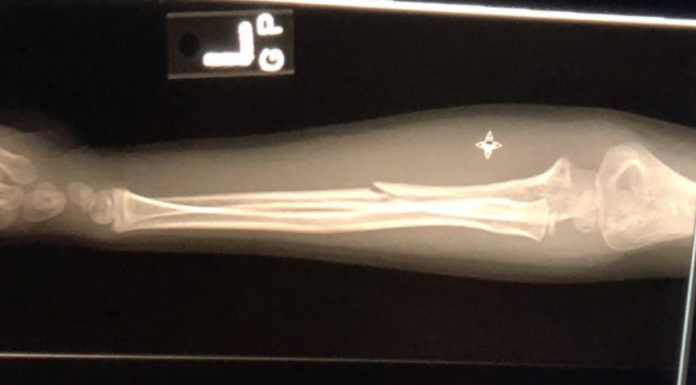 Casts & Kids: 10 Things to do with a Cast in Miami Image: An x-ray of a broken arm