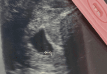 Sonogram image next to a pregnancy test