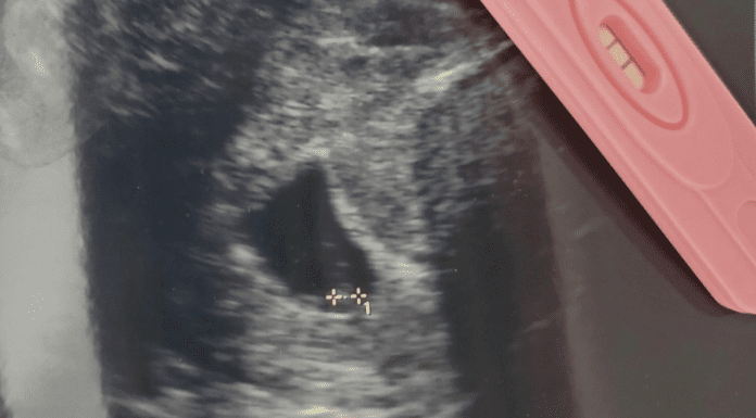 Sonogram image next to a pregnancy test