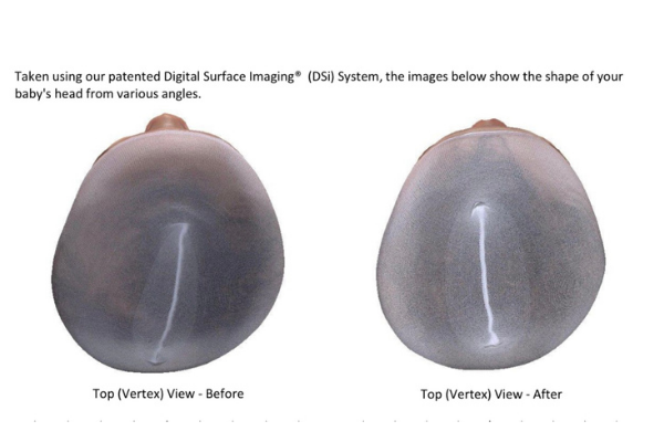 Before and after views of a child's head following cranial helmet treatment (Plagiocephaly and a Cranial Helmet: It's Not As Scary As It Looks Jessica Socarras Contributor Miami Mom Collective)