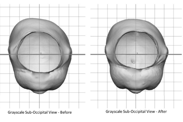 A second set of before and after pictures following cranial helmet treatment (Plagiocephaly and a Cranial Helmet: It's Not As Scary As It Looks Jessica Socarras Contributor Miami Mom Collective)